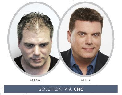 CNC 3D Cranial Prosthesis .